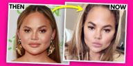 CHRISSY TEIGEN I HAD FACE FAT REMOVED