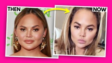 CHRISSY TEIGEN I HAD FACE FAT REMOVED